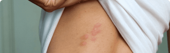 Skin rash that spreads in allover the skin