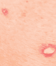 Bed Bug Bites