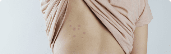 Multiple raised red spots in a straight line