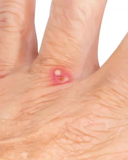 لدغة النمل الناري