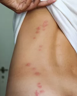 شكل قرصة بق الفراش