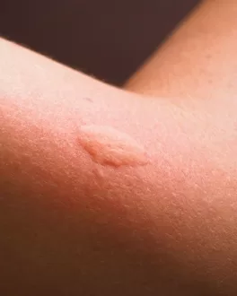 لدغة البعوض