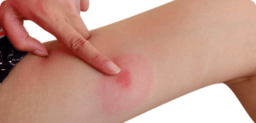 Mosquito Bites