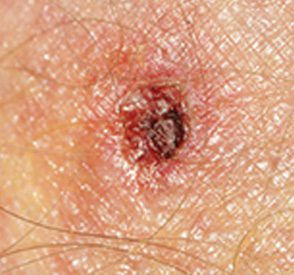 Tick Bites