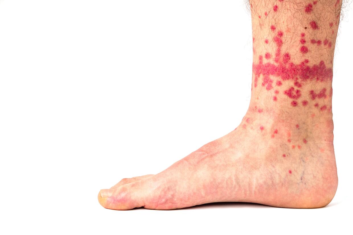 لدغات تظهر حول الكاحلين أو الساقين