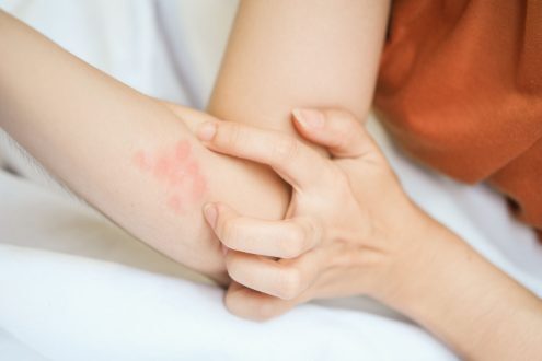 كيفية التخلص من اثار قرص البق