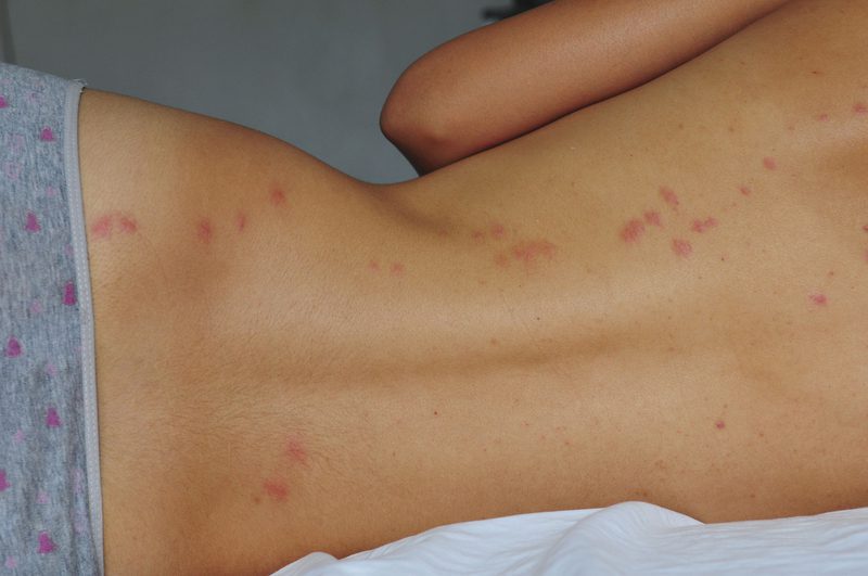 ما هو علاج قرصة البق