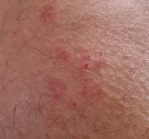 Fleas bites