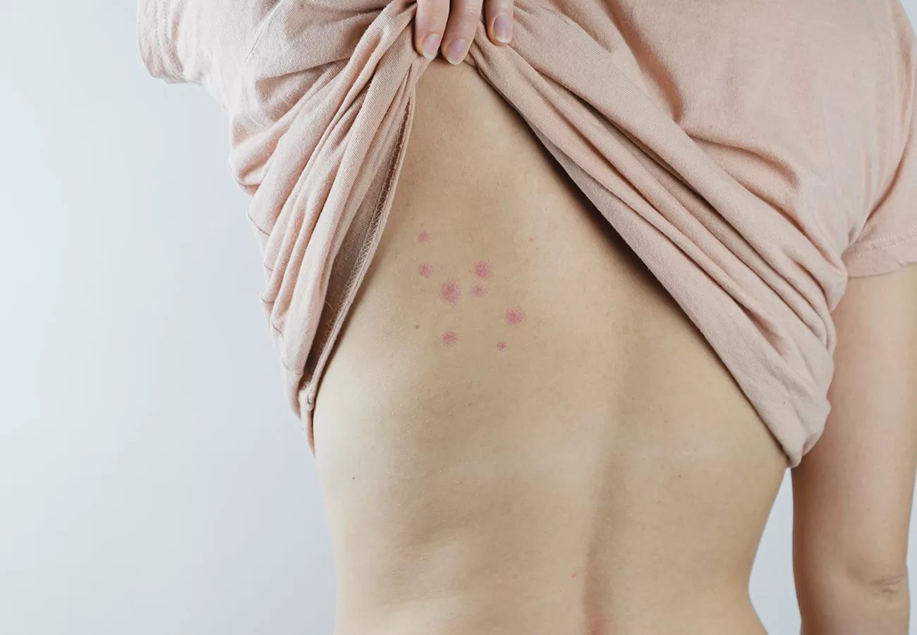 قرصة بق الفراش